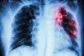 Bệnh lao phổi có phải bệnh truyền nhiễm nguy hiểm không?